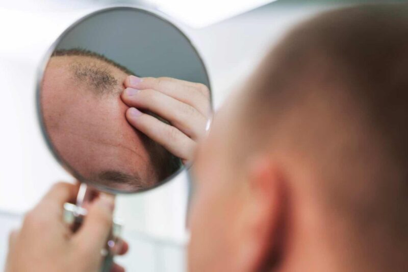 Die Glatze: stillvolle Wahl oder letzter Ausweg?