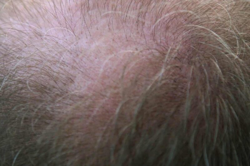 Haarausfall: Problem für Männer 