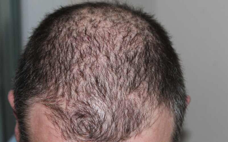 Hilfe gegen kreisrunden Haarausfall 