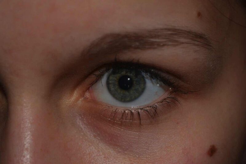 Leberflecken, die man im Auge behalten sollte